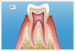 歯周病治療